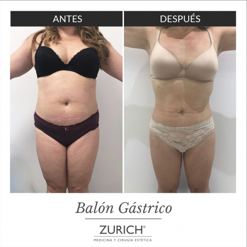 Antes y despu�s � Bal�n G�strico 6 meses